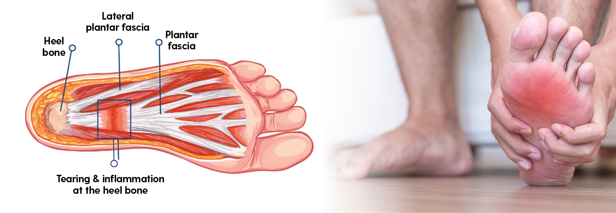 Plantar Fasciitis Blog