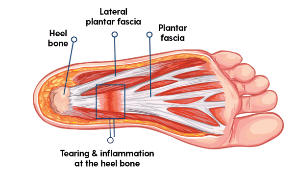 Plantar Fasciitis Blog3